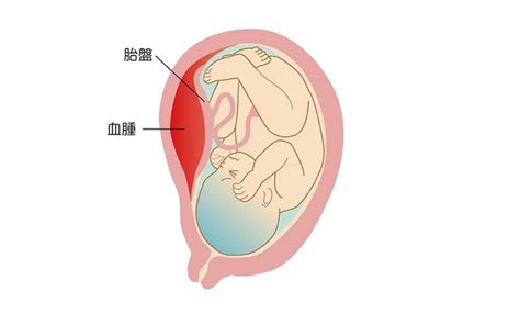 胎盤剝離方式|胎盤早期剝離